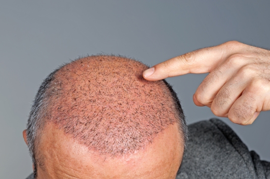 how to regrow balding hair naturally